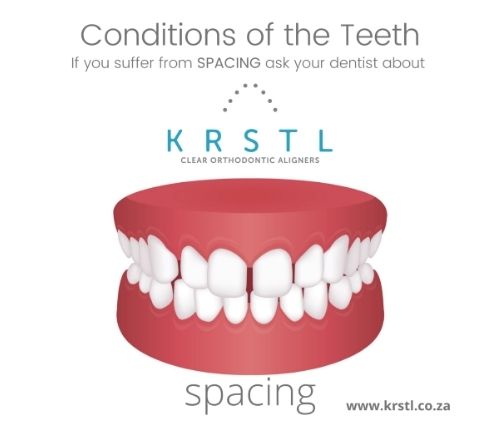 teeth spacing help