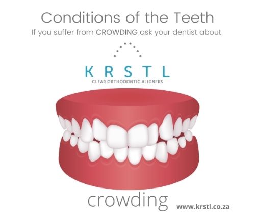 crowding teeth condition help