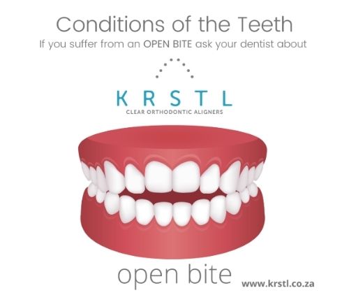 openbite tooth condition help