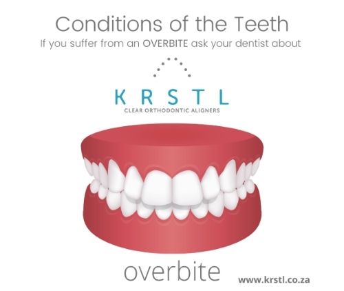 overbite teeth condition help